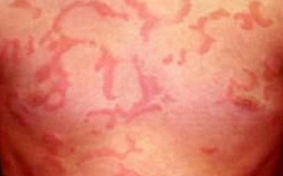 Nổi mề đay do dị ứng thức ăn