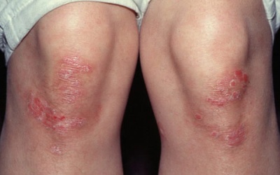 Dự phòng bệnh vẩy nến: Tuy khó mà không khó