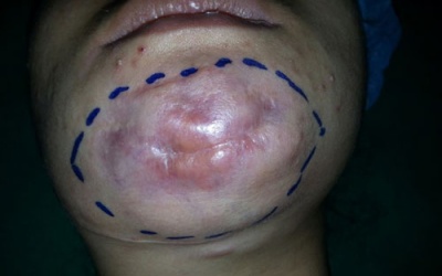 Một cô gái bị hỏng cằm vì bơm silicon lỏng