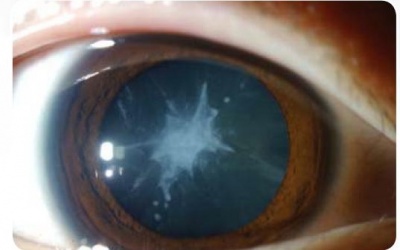 Đục thủy tinh thể: Thủ phạm nguy hiểm gây mù lòa