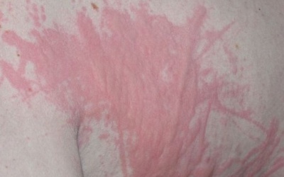 Mề đay giao mùa: Tổng hợp các dạng phức tạp của mề đay