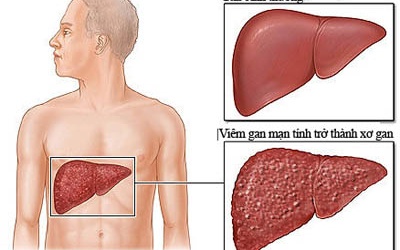 ​Mỗi năm Việt Nam có 16.000 người tử vong vì xơ gan