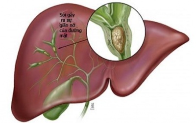 Bệnh viêm gan E liên quan đến mưa lũ
