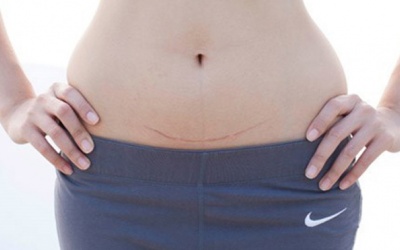 Cách chăm sóc và làm đẹp vết mổ sau sinh