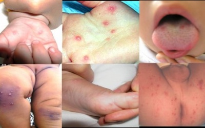 Đà Nẵng: Ca bệnh tay chân miệng tăng gần 2 lần