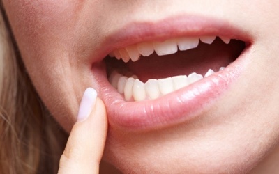 Viêm loét miệng – làm sao để nhanh khỏi?