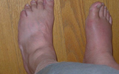 Kinh hãi với những biến chứng của gout