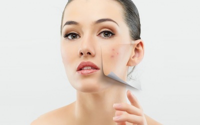 Trị mụn trứng cá ở người trưởng thành 