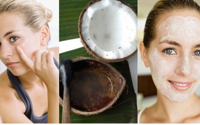 Hết mụn nhờ dầu dừa