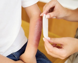 Nhiễm khuẩn vết thương, vết bỏng, chọn thuốc nào?