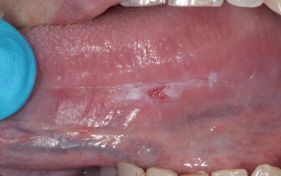 Biểu hiện ung thư lưỡi dễ bị nhầm với nhiệt miệng