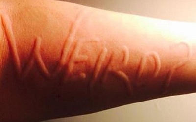 Da vẽ nổi có phải là mề đay?