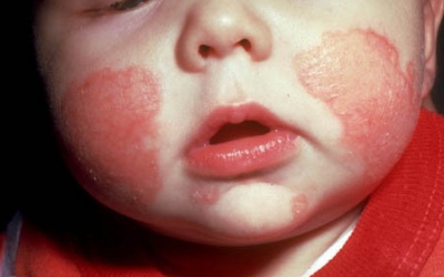 Eczema và các thể bệnh phổ biến nhất