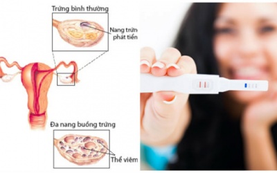 Bị buồng trứng đa nang vẫn mang thai tự nhiên được!