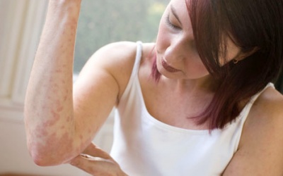 Bệnh chàm có điều trị khỏi hẳn được không?