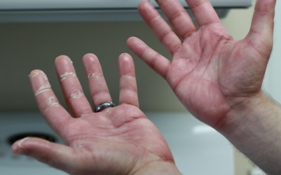 Những biện pháp tự nhiên giúp kiểm soát bệnh vẩy nến