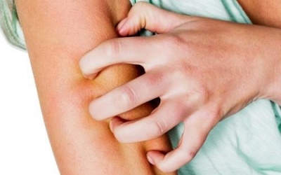 Cách xử trí khi bị côn trùng cắn ai cũng cần phải biết