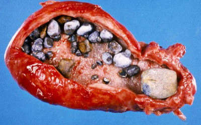 Các biến chứng nguy hiểm của bệnh sỏi mật