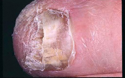 Nấm móng chân có thể chữa khỏi không?