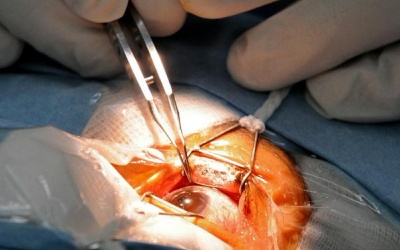 Phẫu thuật đục thủy tinh thể có gây bến chứng?