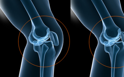 Bổ sung vitamin D và calci qua thực phẩm