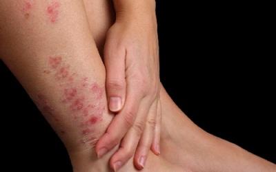 Vẩy nến và các thể bệnh thường gặp nhất