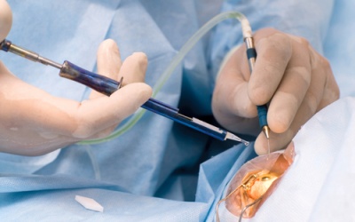 Ca mổ đục thủy tinh thể diễn ra như thế nào?