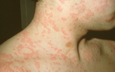 Điều trị mề đay không cần thuốc kháng histamine