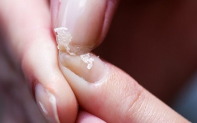 Móng tay giòn dễ gãy biểu hiện bệnh gì?