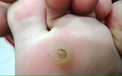 Mụn cóc ở lòng bàn chân, bàn tay chữa thế nào?