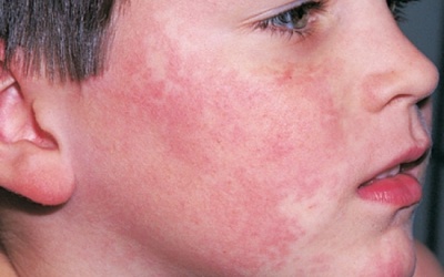 Nguyên nhân và triệu chứng của bệnh lupus ban đỏ