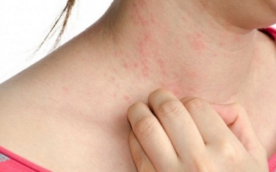 Mề đay tự phát mạn tính: Khó tìm nguyên nhân