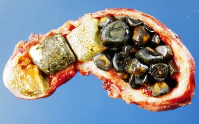 Những điều cần biết về bệnh sỏi mật