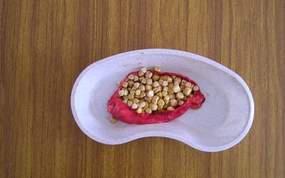 Phân biệt các loại sỏi mật