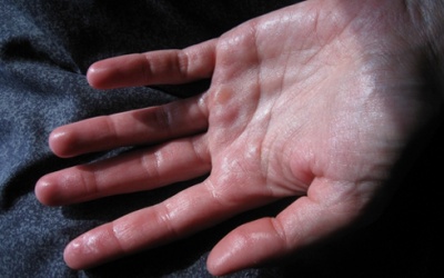 Ra mồ hôi nhiều do rối loạn hệ thần kinh thực vật