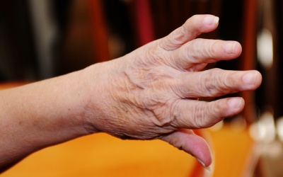 3 biện pháp tự nhiên giúp giảm đau do viêm khớp dạng thấp