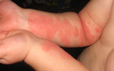 5 mẹo chăm sóc vùng da bị tổn thương do eczema