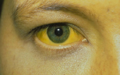 10 triệu chứng cho thấy gan có vấn đề