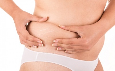 Bí quyết ngăn ngừa và xóa mờ rạn da