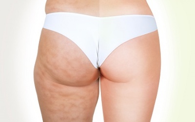 Trị da sần vỏ cam chỉ cần dầu dừa