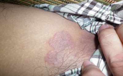 Ngứa bẹn, bệnh gì?