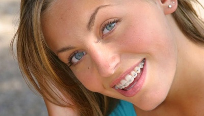 Niềng răng và những điều bạn nên biết