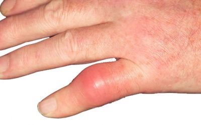 Dùng thực phẩm chức năng hỗ trợ điều trị gout có tốt không?