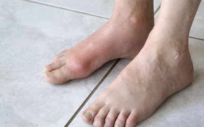 Tăng nguy cơ gout vì lối sống chưa khoa học