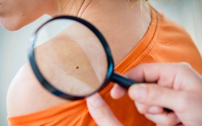 Nốt ruồi bất thường - Cẩn thận u sắc tố ác tính!