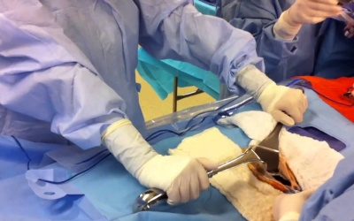 Cắt túi mật mở là gì?