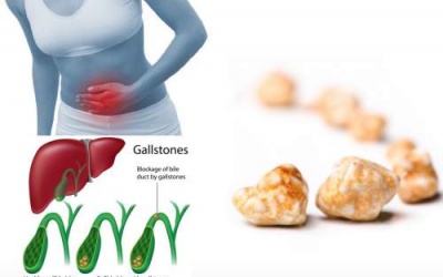 Ai dễ bị sỏi mật 'tấn công'?