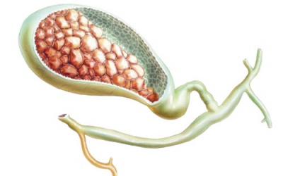 Sỏi mật không triệu trứng: Điều trị thế nào?