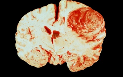 4 “độc tố” gây u não