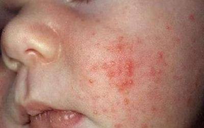 Bệnh viêm da cơ địa có di truyền không?